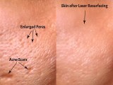 Scar Treatment with Fractional CO2 Laser Skin Resurfacing