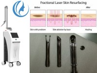 CO2 laser treatment for acne scars
