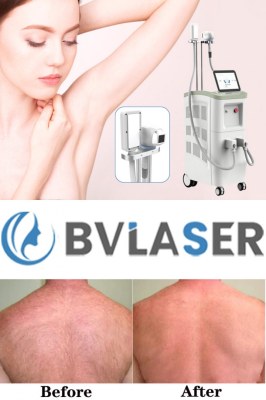 The best professional laser hair removal machine