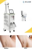 Medical grade laser hair removal machine treatment is safe