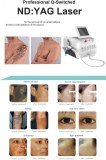 ND YAG Laser for Skin Treatment - Spots Removal