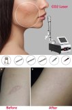 What is CO2 laser resurfacing