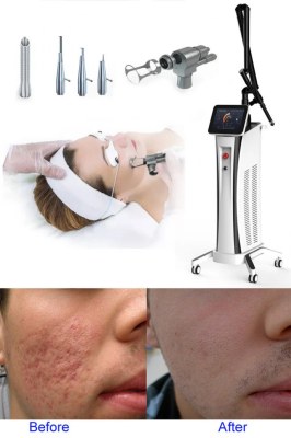 CO2 fractional laser in aesthetic medicine